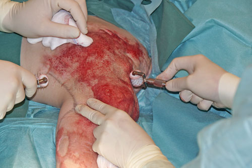 „Surgical Needling“ einer Narbenplatte an der Schulter.
