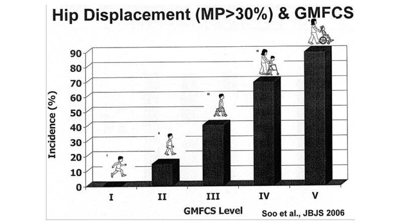 Zusammenhang zwischen der Form der Ausprägung der ICP nach GMFCS und dem Auftreten von Hüftfehlbildungen (Soo et al., JBJS 2006).