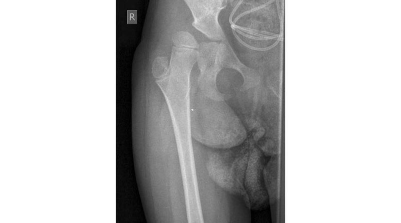Röntgenaufnahme des rechten Hüftgelenks im November 2011.