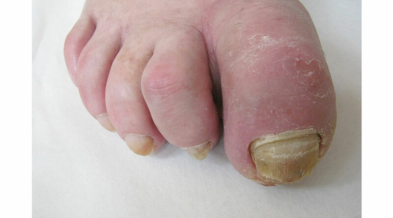 Typische Krallenzehe mit Nagelmykose und -infekt bei Verkürzung von Beuge- und Strecksehne.