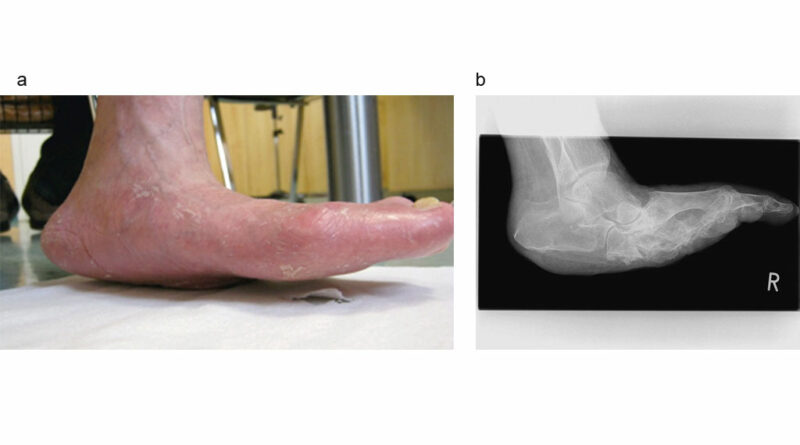 Charcotfuß als Stempelfuß mit Fußwurzelknochenkollaps.