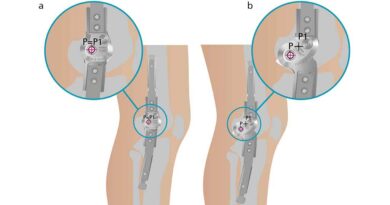Frei bewegliches Systemkniegelenk; a) ohne Rückverlagerung: die Positionierung der mechanischen Knieachse ( P ) ist kongruent zur anatomischen Kompromissachse (P1) nach Nietert; b) mit Rückverlagerung: die Positionierung der mechanischen Knieachse ( P ) erfolgt hinter der anatomischen Kompromissachse (P1) nach Nietert.