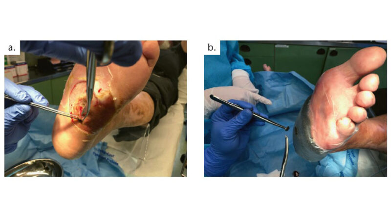 Akuter infizierter Charcot-Fuß; a) Darstellung des akuten infizierten Charcot-Fußes mit plantarem Malum perforans: chirurgisches Debridement, Desinfektion; b) Darstellung der angebrachten Vakuumversiegelung.