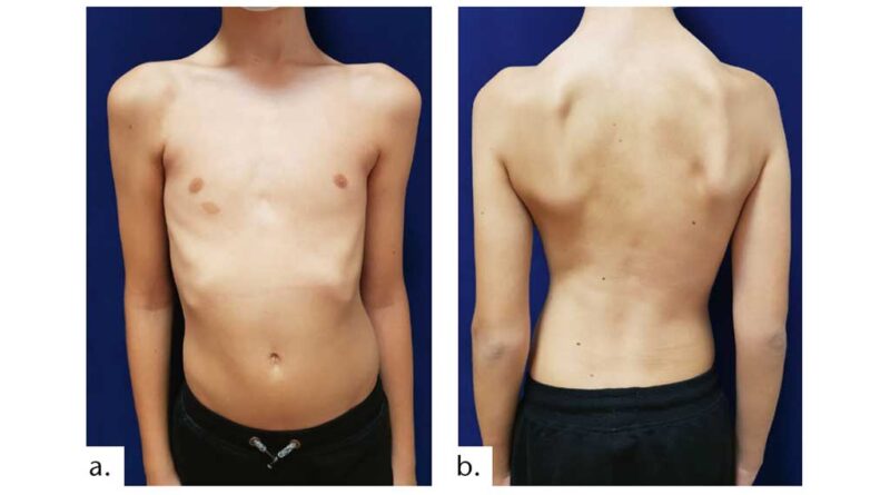 Fallbeispiel 2: 13-jähriger Patient mit auffällig asymmetrischem Rumpf; es liegt eine idiopathische Skoliose mit zusätzlichen prominenten Rippenbögen und vorrotierten Schultern vor; a) Vorderansicht; b) Rückansicht.