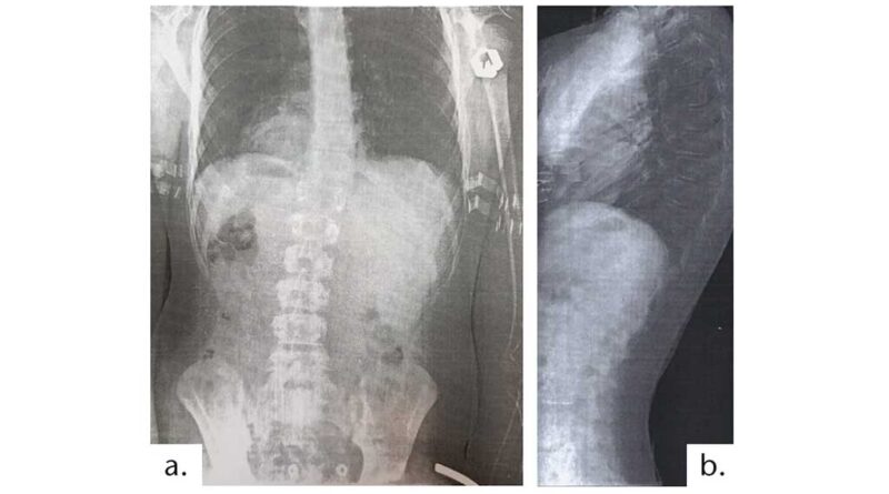 Fallbeispiel 2: Röntgenbefund für einen 14-jährigen Skoliosepatienten.