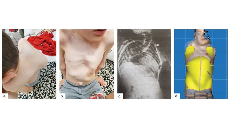 Fallbeispiel 4: Patient mit Ehlers-Danlos-Syndrom und Mitochondriopathie. a) Der massive Gibbus ist im thorakalen Bereich erkennbar. Dieser entsteht durch das Herauspressen der Skapula aus dem konkaven Anteil der Skoliose durch das Zusammenstauchen der Rippen. b) Zusätzlich zur Skoliose hat sich der gesamte frontale Brustkorb deformiert und folgt der dreidimensionalen Verbiegung der Wirbelsäule. c) Röntgenbefund: Cobb-Winkel 110 Grad, zusätzlich eine 90-Grad-Krümmung im HWS-Bereich, die fast in einem Stück verlaufende 11. Rippe und der Beckenkamm. d) Screenshot (Rodin4D Neo) mit eingeblendetem Korsettentwurf und Schattenbild des Patientenscans mit den auf den prominenten Stellen platzierten Markern.