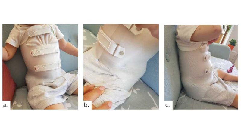Fallbeispiel 1: a) Zweijähriger Spina-bifida-Patient, der mit angelegtem Korsett frei sitzen kann und die Hände nicht zum Abstützen benötigt. b) Der 3D-Druck erleichtert das individuelle Gestalten von Korsetten; Wandstärken können frei gewählt und nach Bedarf konstruiert werden. c) Ohne das Material oder die Konstruktion zu schwächen, trägt eine großflächige Perforation zu einem optimierten Mikroklima innerhalb des Hilfsmittels bei.