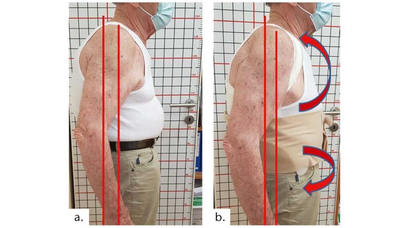 Fallbeispiel 3: Vergleich der Oberkörperhaltung beim Patienten ohne (a) und mit (b) Hilfsmittel. Der Schwerpunkt des Patienten verschiebt sich um ca. 15 mm nach posterior und entlastet damit den unteren Rumpfstrecker. Aufnahme (b) stammt aus der Anprobephase; das textile Leibteil wurde für die finale Version in die Konstruktion integriert und ebenfalls gedruckt.