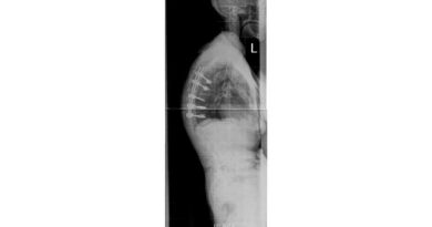 Wirbelsäulenganzaufnahme einer Patientin nach Korrektur einer Hyperkyphose der Brustwirbelsäule nach osteoporotischen Wirbelkörperfrakturen.