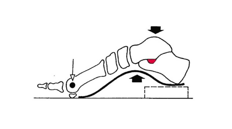 Die Abbildung zeigt die Diskrepanz zwischen dem höchsten Punkt der anatomischen Längswölbung und dem weiter hinten am Fersenbein befindlichen Sustentaculum tali (rot).