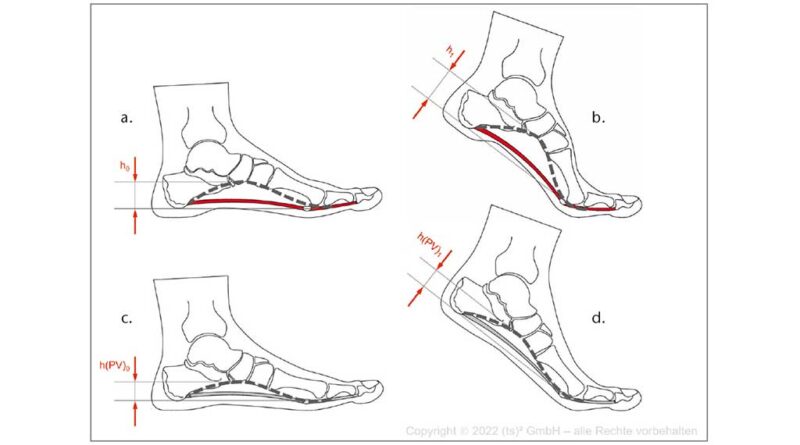 Vergleich der physiologischen Fußstellung (a u. b) mit der Knick-Senkfuß-Fehlstellung (c u. d) in Bezug auf den Windlass-Mechanismus während der Lokomotion; a) Höhe des medialen Längsbogens des Mittel- und Rückfußbereichs (h0) bei Belastung des gesamten Fußes in der mittleren Standphase des Gangzyklus; b) Vorfußbelastung in der späten Standphase mit Verspannung der plantaren Strukturen (Plantaraponeurose, rot gekennzeichnet) und daraus resultierend physiologische Aufrichtung des medialen Längsbogens (h1 > h0) sowie Verriegelung des Mittel- und Rückfußbereichs; c) Knick-Senkfuß-Fehlstellung mit reduzierter Höhe des medialen Längsbogens des Mittel- und Rückfußbereichs (h(PV)0) und „überdehnten“ plantaren Strukturen (Plantaraponeurose, grau gekennzeichnet); d) Vorfußbelastung während der späten Standphase mit reduzierter oder aufgehobener Spannung der plantaren Strukturen, fehlender Aufrichtung der Höhe des medialen Längsbogens (h(PV)1 = h(PV)0) und fehlender Verriegelung des Mittel- und Rückfußbereichs.
