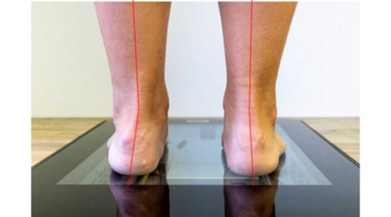Achsab­weichungen an der Basis ­stehen oft in einem komplexen Zusammenhang, der bei der Konzeption von physiologisch-funktionalen dynamischen Fußorthesen berücksichtigt werden muss; Fußstellung.