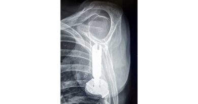 Röntgenbild Implantat.