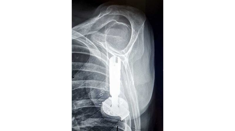 Röntgenbild Implantat.