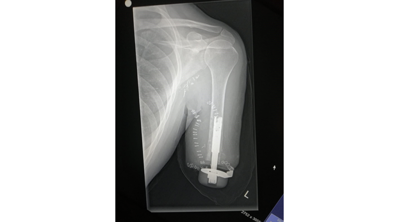 Röntgenbild nach der Osseointegration mit dem Implantat.