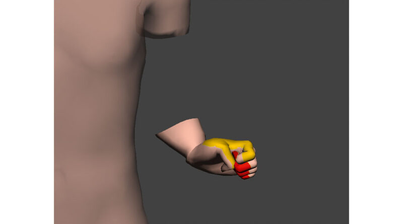 Illustration der Phantompräsenz (distaler Unterarm und Hand) und wie das Phantom für den Patienten aussieht und sich anfühlt. Leichte und starke Schmerzen sind basierend auf der NRS-Skala in der Abbildung gelb bzw. rot dargestellt.