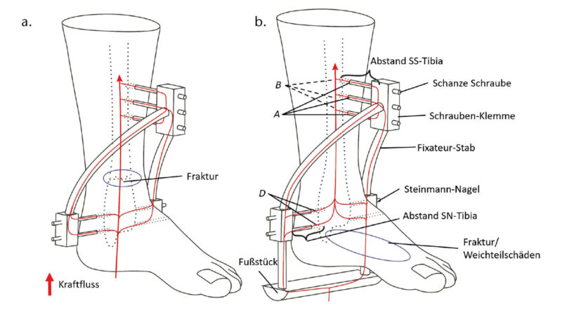 Fixateur-Untersuchungen mit paralleler Kraftübertragung. b) Überbrückung des Fußes mit Krafteinleitung in der Tibia (SS = Schanze Schraube, SN = Steinmann-Nagel).