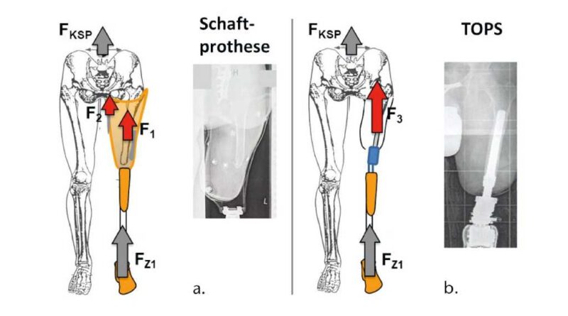 Schema zur Kraftübertragung der Vertikalkomponente der Bodenreaktionskraft FZ1 vom Fuß über die Prothese auf den Körperschwerpunkt (KSP). Bei der Schaftprothese teilt sich die Bodenreaktionskraft zwischen Schaft und Körper über zwischenliegende Weichteile in zwei Teilkräfte – F1 vom Schaft zum Femur und F2 vom Schaft zum Becken (a). Bei der transkutanen osseointegrierten Prothese (TOPS) wirkt die Bodenreaktionskraft vom Implantat direkt zum Femur als F3 (b). Die Kraft Fksp verursacht die Vertikalbewegung des Körperschwerpunkts.
