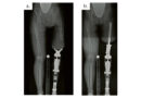 Lateralisiertes Femur im Schaft (a), Achskorrektur durch TOPS (b).