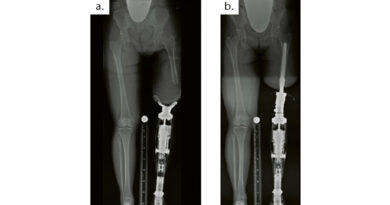 Lateralisiertes Femur im Schaft (a), Achskorrektur durch TOPS (b).