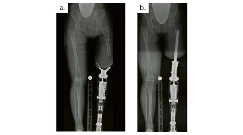 Lateralisiertes Femur im Schaft (a), Achskorrektur durch TOPS (b).