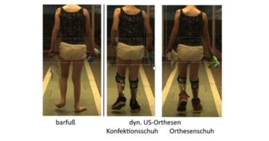 Hilfsmittelüberprüfung und -optimierung mittels Video-Ganganalyse.