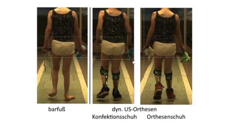 Hilfsmittelüberprüfung und -optimierung mittels Video-Ganganalyse.