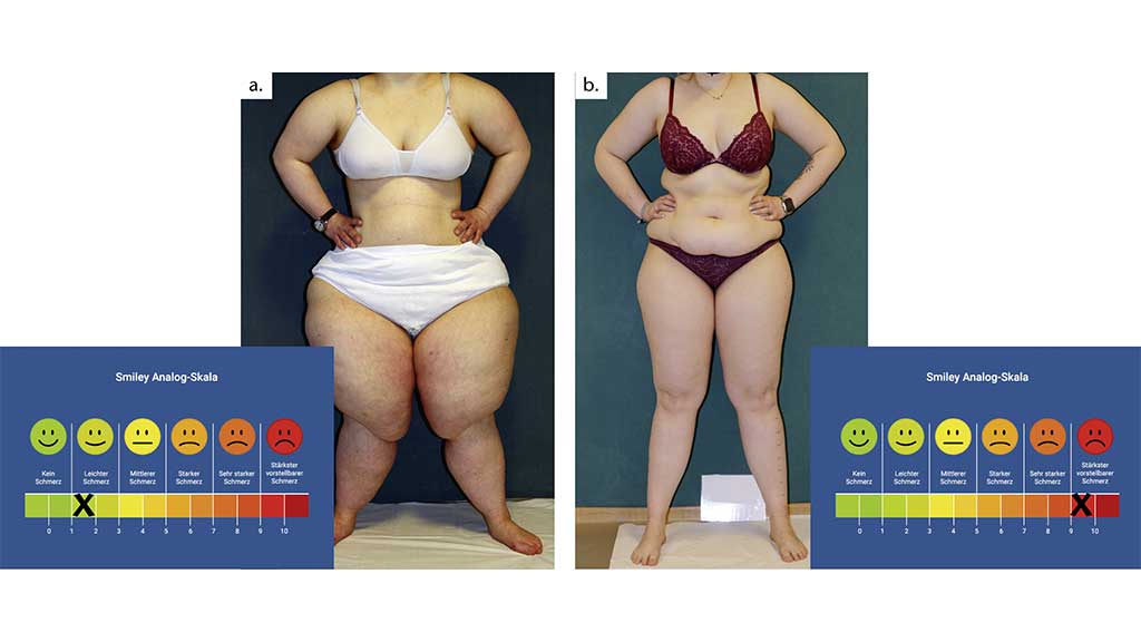 Abb. 1a u. b Selbsteinschätzung von Patientinnen auf einer visuellen Analogskala (VAS von 0–10).