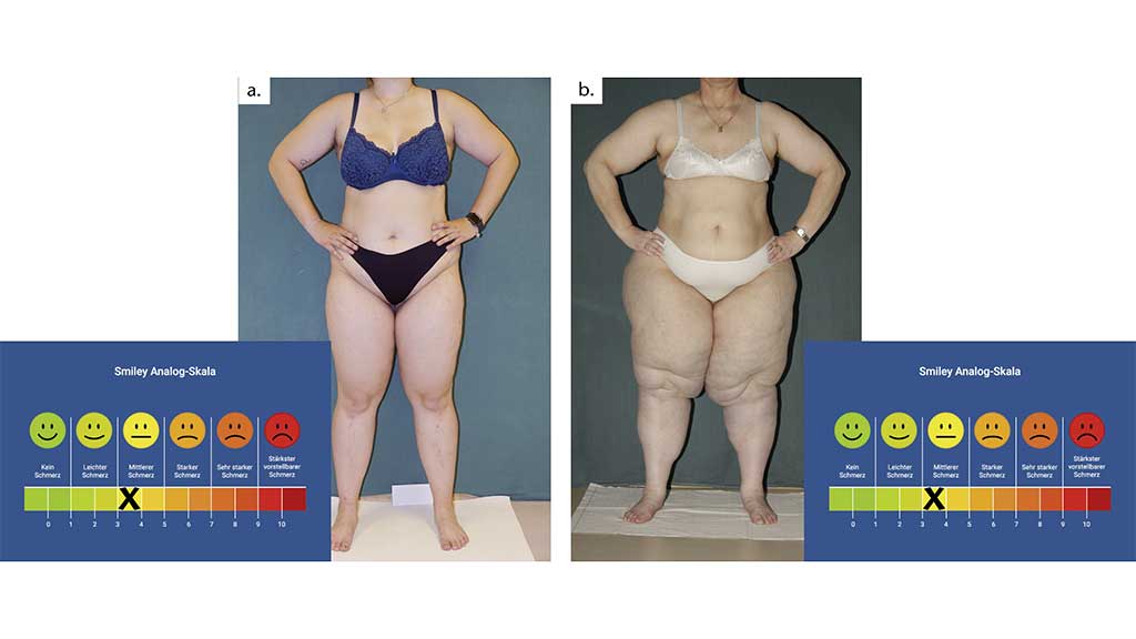 Abb. 2a u. b Selbsteinschätzung von Patientinnen auf einer visuellen Analogskala (VAS von 0–10).