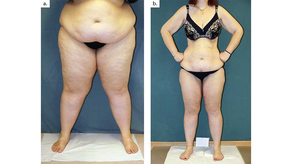 Abb. 3a u. b Der Vergleich dieser Patientin mit Adipositas und Lipödem vor der Behandlung (a) und zehn Monate später (b) macht den Erfolg der Adipositaschirurgie deutlich. 