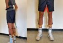 Kei­ne Aus­wir­kun­gen einer vier­wö­chi­gen ­kom­bi­nier­ten ­Kor­sett- und Schroth-The­ra­pie bei mode­ra­ter idio­pa­thi­scher ado­les­zen­ter Sko­lio­se auf die plant­are Druckverteilung