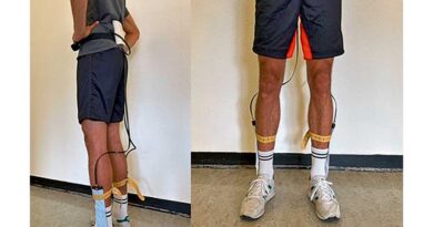 Kei­ne Aus­wir­kun­gen einer vier­wö­chi­gen ­kom­bi­nier­ten ­Kor­sett- und Schroth-The­ra­pie bei mode­ra­ter idio­pa­thi­scher ado­les­zen­ter Sko­lio­se auf die plant­are Druckverteilung
