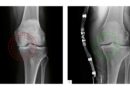 <img class="new_ribbon" width="25" height="25" src="https://360-ot.de/wp-content/uploads/2020/01/pluslogo.png">Knie­ar­thro­se – Erfah­run­gen bei der Ver­sor­gung mit einer Orthe­se mit dyna­mi­schem 3‑Punkt-Zug­sys­tem