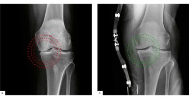 <img class="new_ribbon" width="25" height="25" src="https://360-ot.de/wp-content/uploads/2020/01/pluslogo.png">Knie­ar­thro­se – Erfah­run­gen bei der Ver­sor­gung mit einer Orthe­se mit dyna­mi­schem 3‑Punkt-Zug­sys­tem