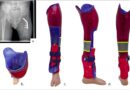 <img class="new_ribbon" width="25" height="25" src="https://360-ot.de/wp-content/uploads/2020/01/pluslogo.png">Ortho­pä­die­tech­ni­sche Ver­sor­gung bei lon­gi­tu­di­na­len Reduk­ti­ons­de­fek­ten der unte­ren Extremität