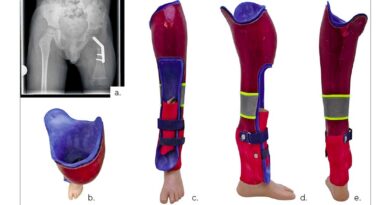 <img class="new_ribbon" width="25" height="25" src="https://360-ot.de/wp-content/uploads/2020/01/pluslogo.png">Ortho­pä­die­tech­ni­sche Ver­sor­gung bei lon­gi­tu­di­na­len Reduk­ti­ons­de­fek­ten der unte­ren Extremität