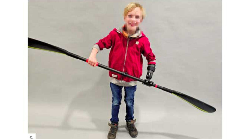 Individuell gefertigte Paddelhilfe bei Unterarmperomelie (Orthopädietechnik Münsterland).