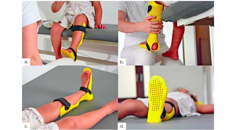 Passform der Lagerungsorthese an einer 8 Jahre alten Patientin mit infantiler Cerebralparese.