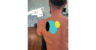 <img class="new_ribbon" width="25" height="25" src="https://360-ot.de/wp-content/uploads/2020/01/pluslogo.png">Fin­ger­phan­to­me in der Pro­the­sen­hand – Pilot­stu­die an einem arm­am­pu­tier­ten Patienten