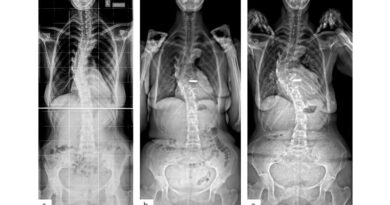 <img class="new_ribbon" width="25" height="25" src="https://360-ot.de/wp-content/uploads/2020/01/pluslogo.png">Über­blick über die Sko­lio­se­ty­pen: Mög­lich­kei­ten und Limi­ta­tio­nen der Kor­sett­the­ra­pie im Wachstumsalter