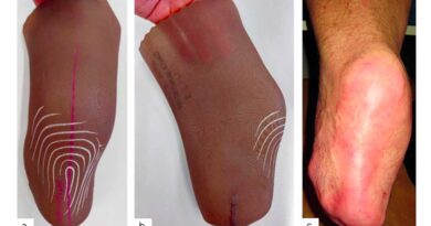 <img class="new_ribbon" width="25" height="25" src="https://360-ot.de/wp-content/uploads/2020/01/pluslogo.png">Liner in der Unterschenkel-Prothetik