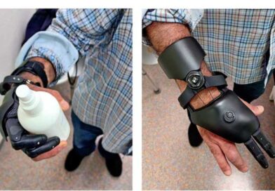 <img class="new_ribbon" width="25" height="25" src="https://360-ot.de/wp-content/uploads/2020/01/pluslogo.png">Teilhandprothese aus dem 3D-Drucker