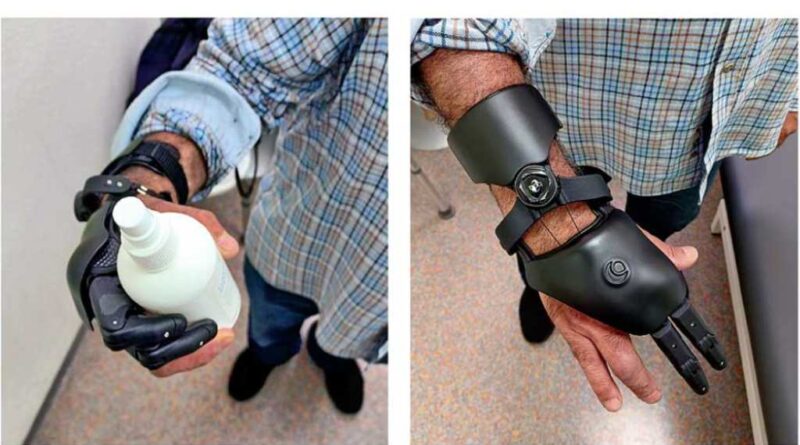 <img class="new_ribbon" width="25" height="25" src="https://360-ot.de/wp-content/uploads/2020/01/pluslogo.png">Teilhandprothese aus dem 3D-Drucker