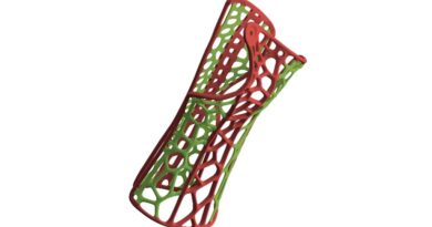 <img class="new_ribbon" width="25" height="25" src="https://360-ot.de/wp-content/uploads/2020/01/pluslogo.png">Gips oder Orthe­se bei dista­len Radiusfrakturen?